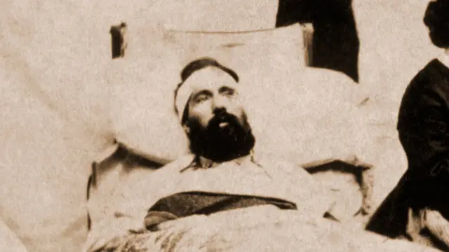 Un herido durante la Guerra Civil en EE.UU.