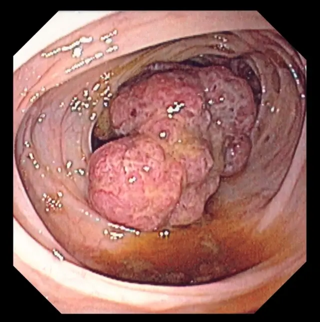 پولیپ سرطانی روده بزرگ در کولونوسکوپی