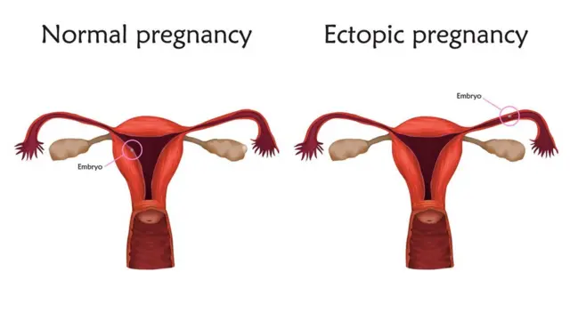 ఎక్టోపిక్ ప్రెగ్నన్సీ