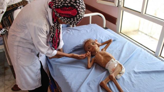 ممرضة تعنى بطفل يمني يعاني من سوء التغذية
