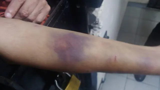 ਮੇਹੁਲ ਚੌਕਸੀ ਦੇ ਵਕੀਲ ਦਾ ਦਾਅਵਾ ਹੈ ਕਿ ਉਸ ਦੇ ਕਲਾਈਂਟ ਦੇ ਪਿੰਡੇ ਉੱਪਰ ਨੀਲ ਕਿਸੇ ਬਿਜਲਈ ਉਪਕਰਨ ਕਾਰਨ ਪਏ ਹਨ