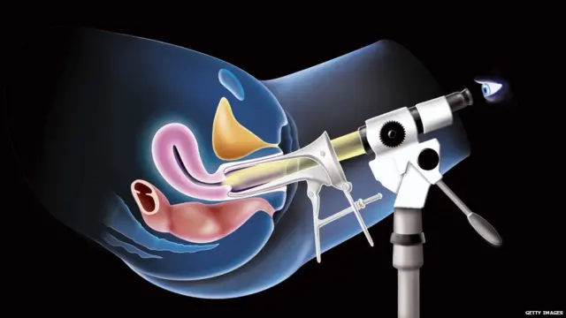 ਬੱਚੇਦਾਨੀ ਦੇ ਮੂੰਹ ਦਾ ਕੈਂਸਰ