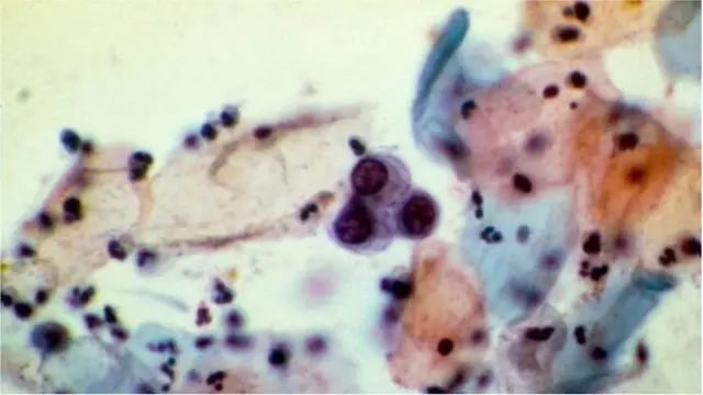 గర్భాశయం కండరాలలో వచ్చే కణుతుల వలన గర్భాశయం పరిమాణం పెరుగుతుంది