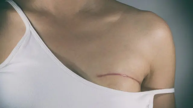 Mujer con cicatriz de mastectomía.