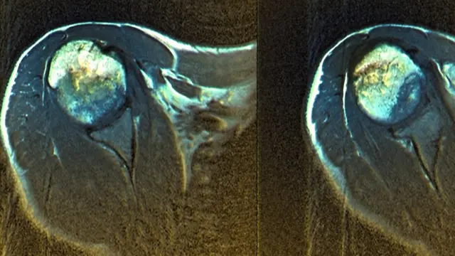 Este es un escáner del hombro de un hombre de 50 años que sufre de algodistrofia.