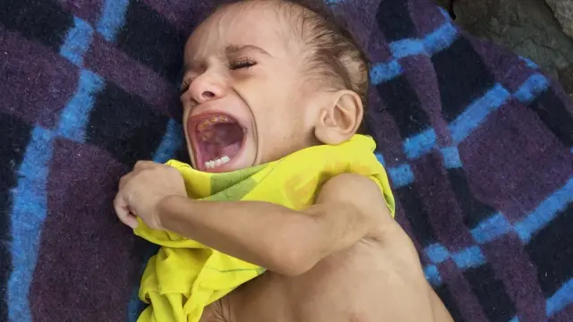 Yemen'de açlık