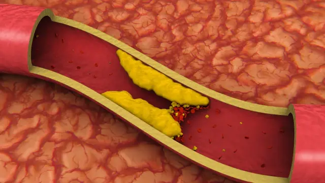 Ilustraçãomister jack betsum vaso sanguíneo obstruído por gordura