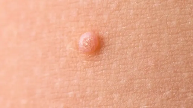 مولوسکوم یا زگیل آبکی