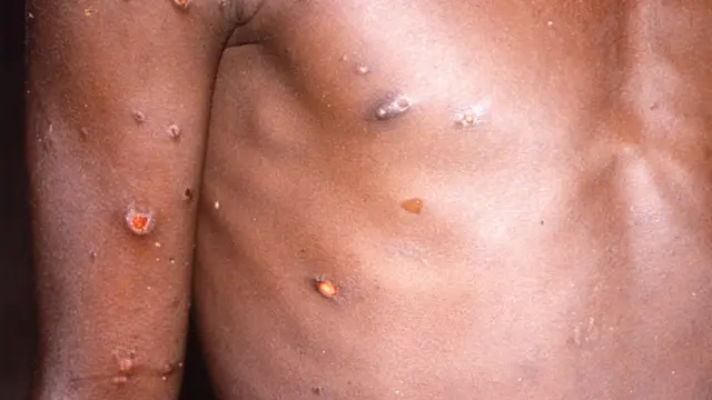 Personne dont le corps est affecté par la variole du singe