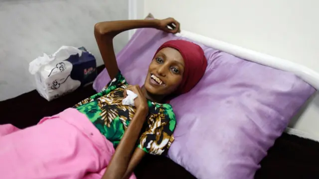 Yemen'de açlık çekmiş bir kadın hastanede