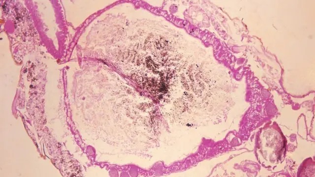 Esta microfotografía muestra el estómago de un mosquito anopheles con el Plasmodium vivax gametes, el parásito que causa la malaria.