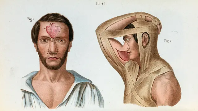 a la izquierda el método indio y, a la derecha, el método italiano.