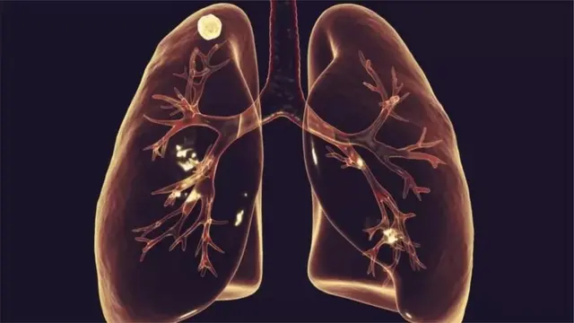 TB ya mapafu imezoeleka kwa watu wazima