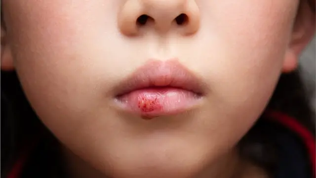 చలికాలంలో చర్మ సంరక్షణ