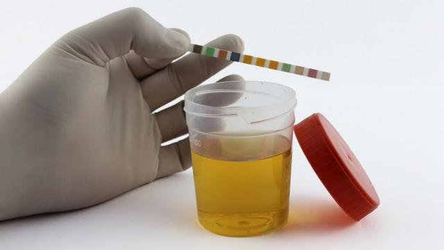 Examen con tira reactiva de orina