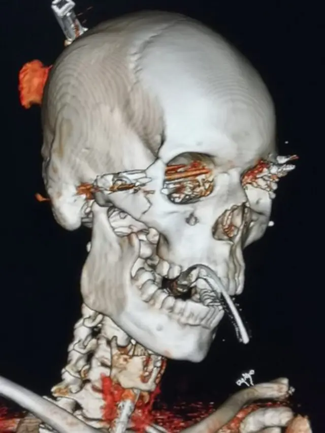 Trayectoria de la bala.