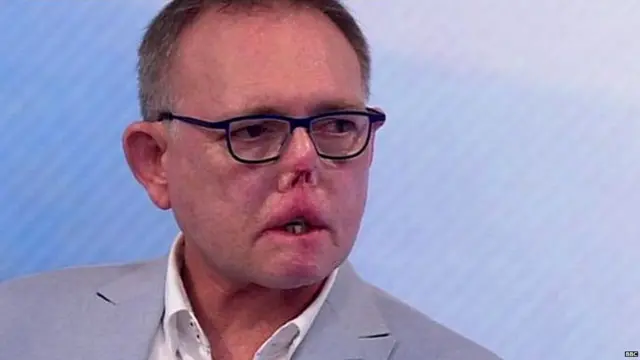 सेप्टिसीमिया, संक्रमण