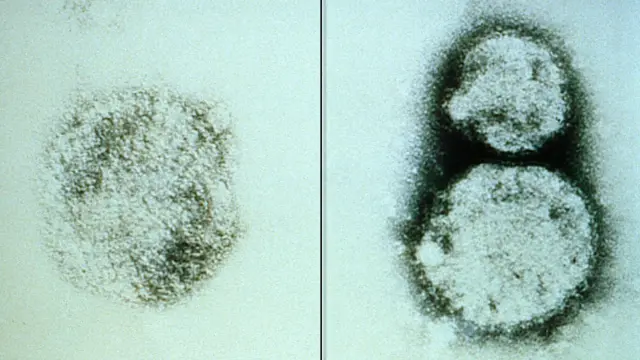 Hantavirus.