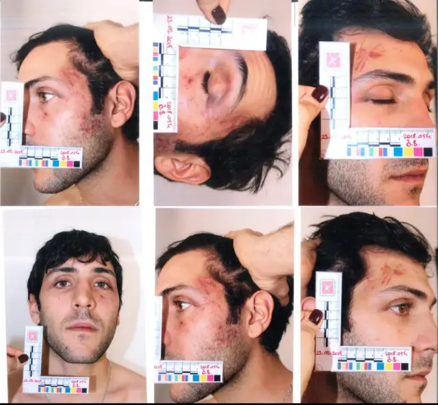 İşkence iddialarını dile getiren öğrencilerden Özgür Benol'un epikriz raporundan