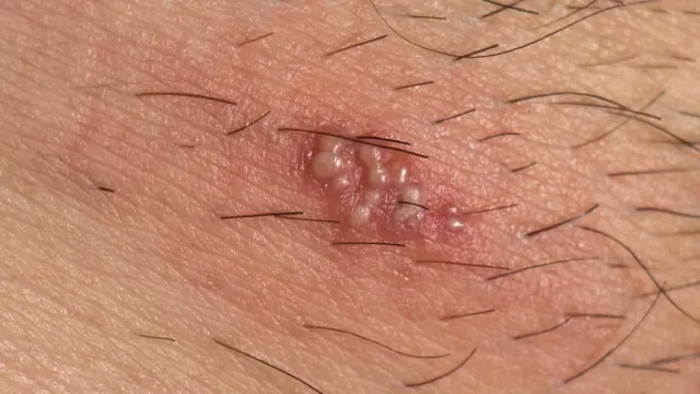 Detalle de las vesículas o ampollas del herpes zóster.