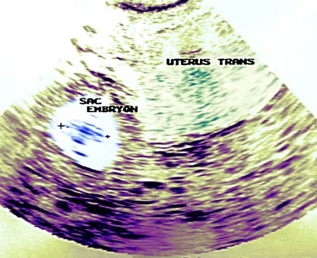 ایکٹوپک حمل