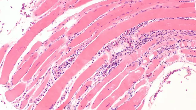 मायोसिटिस-प्रातिनिधीक फोटो