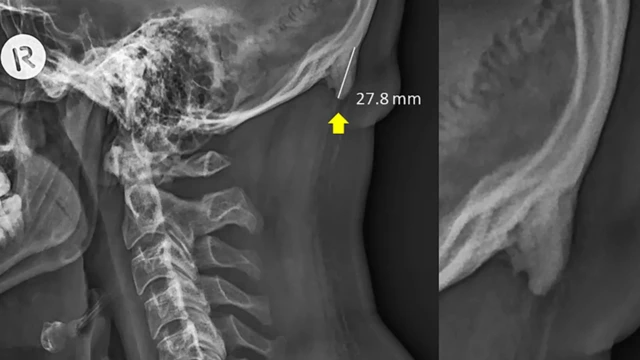 Cráneo con una protuberancia