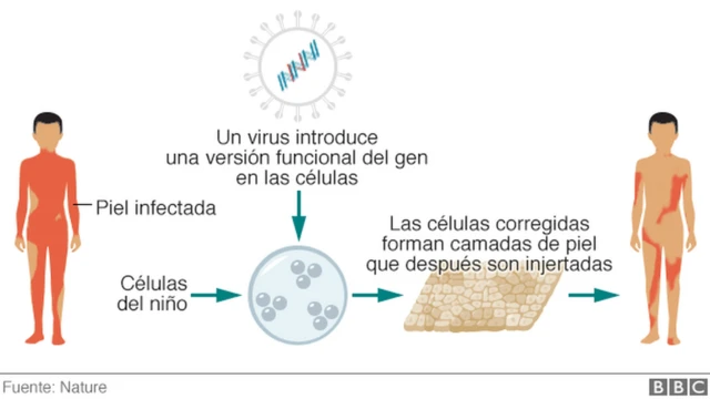 Ilustración que muestra la técnica de crear una nueva piel e injerto.
