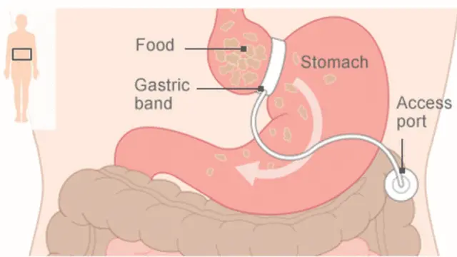 இரண்டு வகை இரைப்பை சிகிச்சை