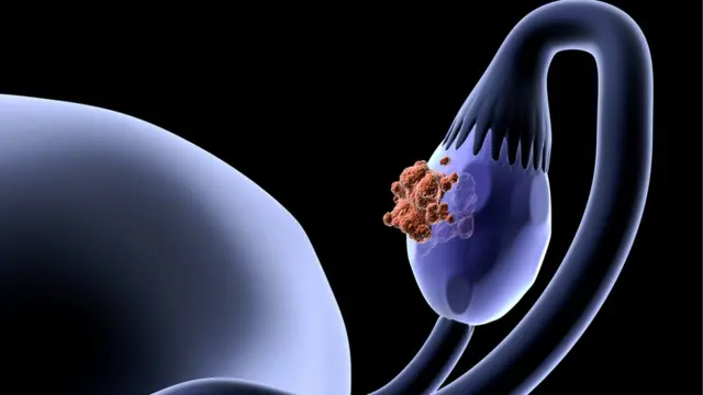 Imagen de un ovario con exceso de masa.