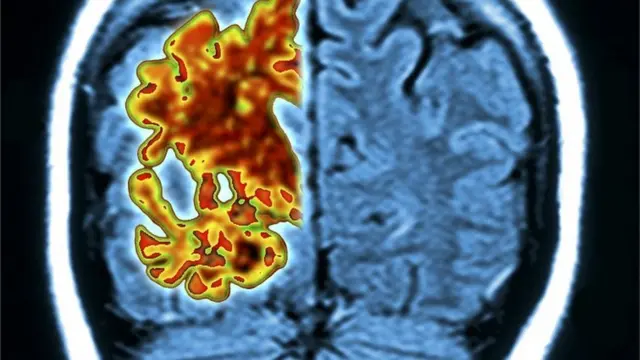 Cérebrokbetspaciente com Alzheimer, mostrando degeneração cerebral