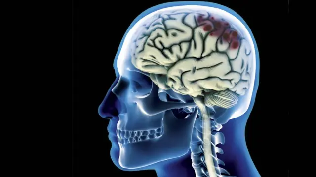 Un escáner genérico de una lesión cerebral