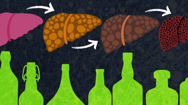 Gráfico: hígado dañado por el alcohol