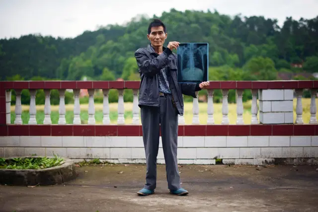 一名湖南的塵肺病患者。