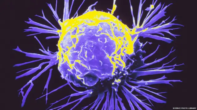 Breast cancer cell. Coloured scanning electron micrograph (SEM) of a single breast cancer cell, showing its uneven surface and cytoplasmic projections.