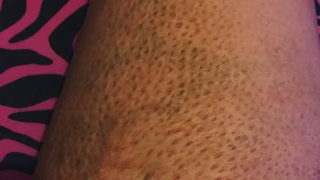 Marcas en la piel de Sylvia, de donde los médicos sacaron piel para hacer injertos.