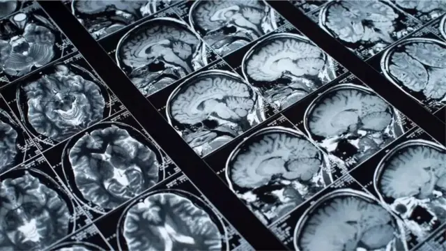 Picha zinazoonesha ubongo