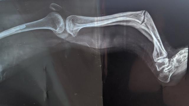 Radiographie de la jambe fracturée de Beatriz