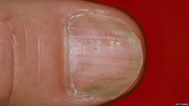 ਸੋਰਾਸਿਸ