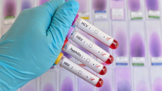 Examesaajogo casinosangue para diagnósticoaajogo casinoISTs