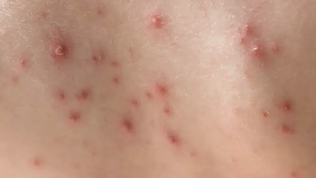 الجديري المائي