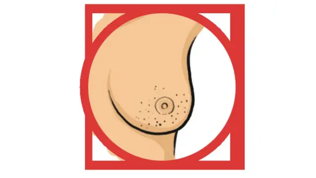 بریسٹ کینسر