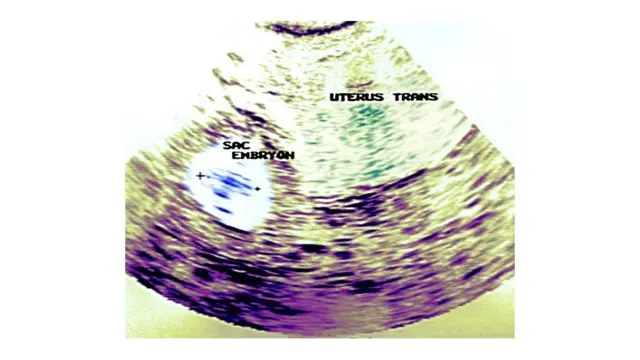 गर्भधारणेचा स्कॅन फोटो