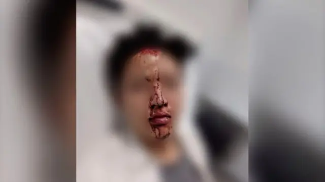 艾倫（化名）流血的臉部