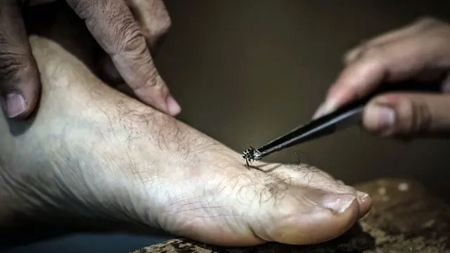 मधमाशी उपचारः एकनाथ खडसे म्हणतात त्याप्रमाणे मधमाशी चावल्यामुळे गुडघेदुखी बरी होते का?