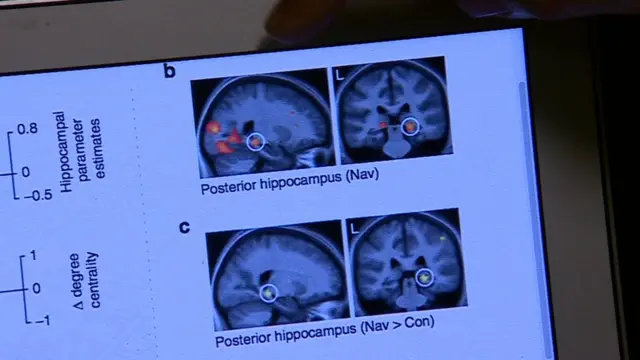 திசையறியும் மனித மூளையின் பகுதி செயலிழப்பதாக கண்டுபிடிப்பு