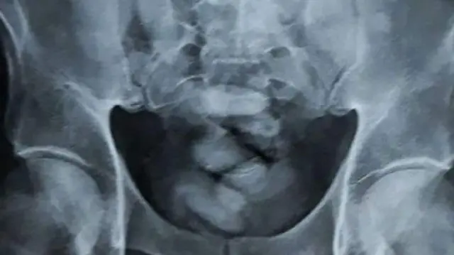 Kookeenii lammiin Keeniyaa liqimsee X-Ray ykn carallaadhaan garaa isaa keessatti argame.