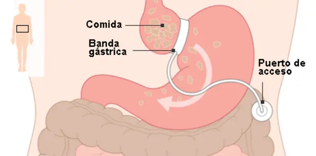 Cirugía bariátrica
