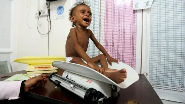 انتشار گزارش از کودکانی که قحطی آنها را نابود می کند در توجه به بحران یمن موثر بوده