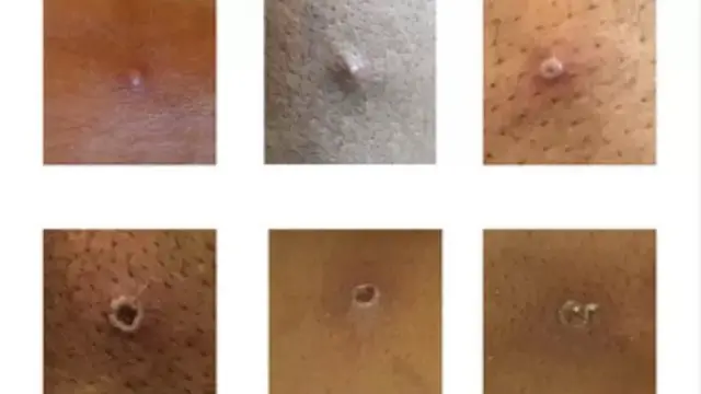 মাংকি পক্সের গুটি